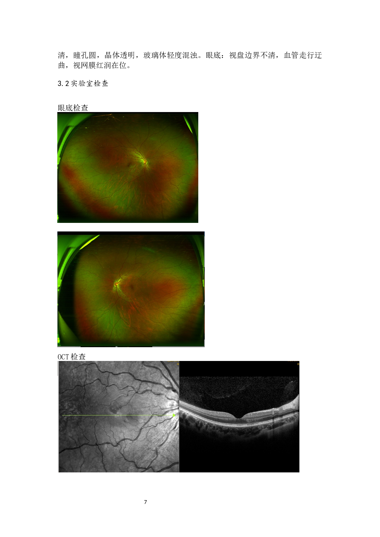 新冠病毒引起的常见眼病分析-9047字.docx 第9页