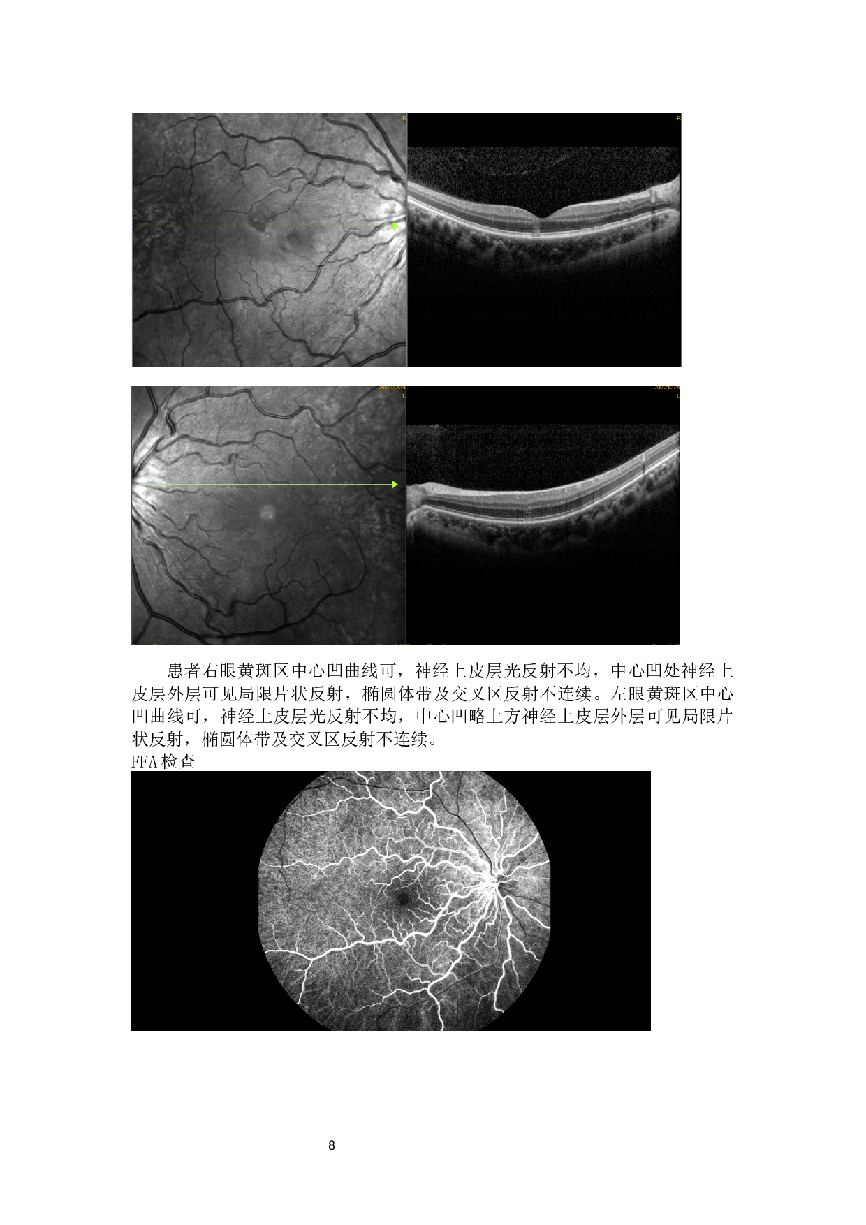 新冠病毒引起的常见眼病分析-9047字.docx 第10页